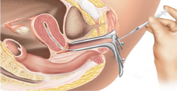 Inseminación intrauterina