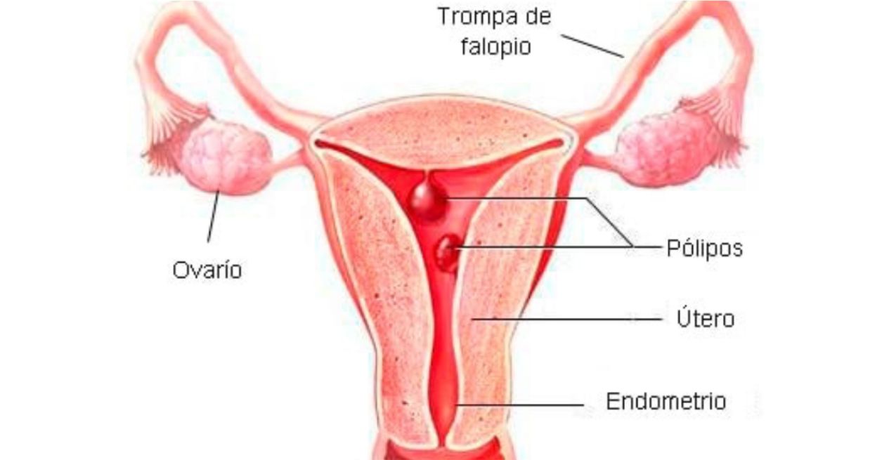 Pólipos endometriales